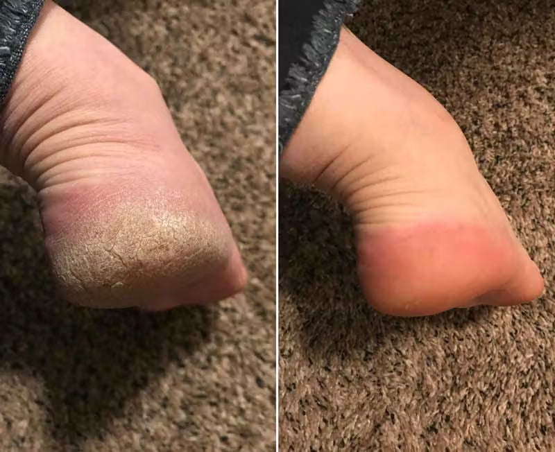 DermaFeet Pro 2.0