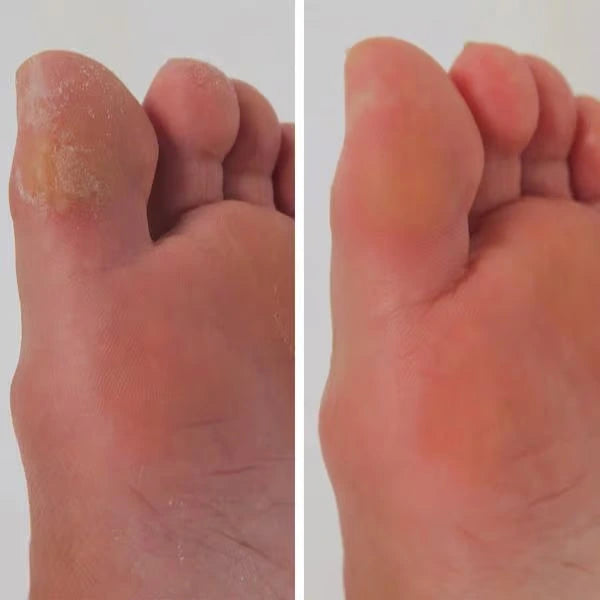 DermaFeet Pro 2.0
