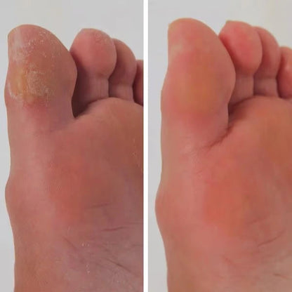 DermaFeet Pro 2.0